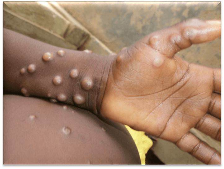 What Detroit is doing about the Monkeypox Outbreak