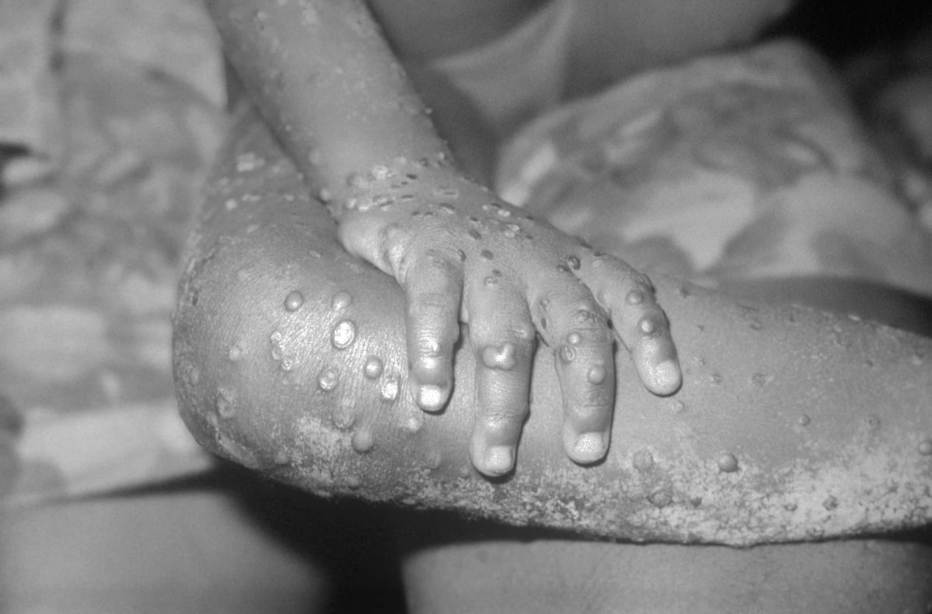 Monkeypox lesions. Photo courtesy of the Centers for Disease Control and Prevention.
